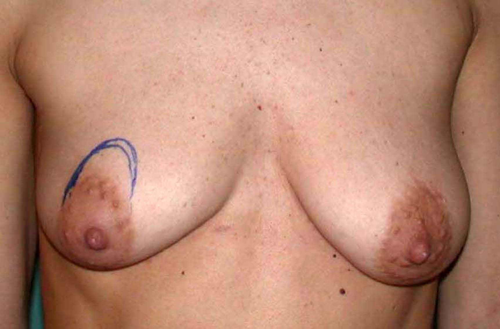 chirurgie-esthétique-correction-ptose-avec-implants12