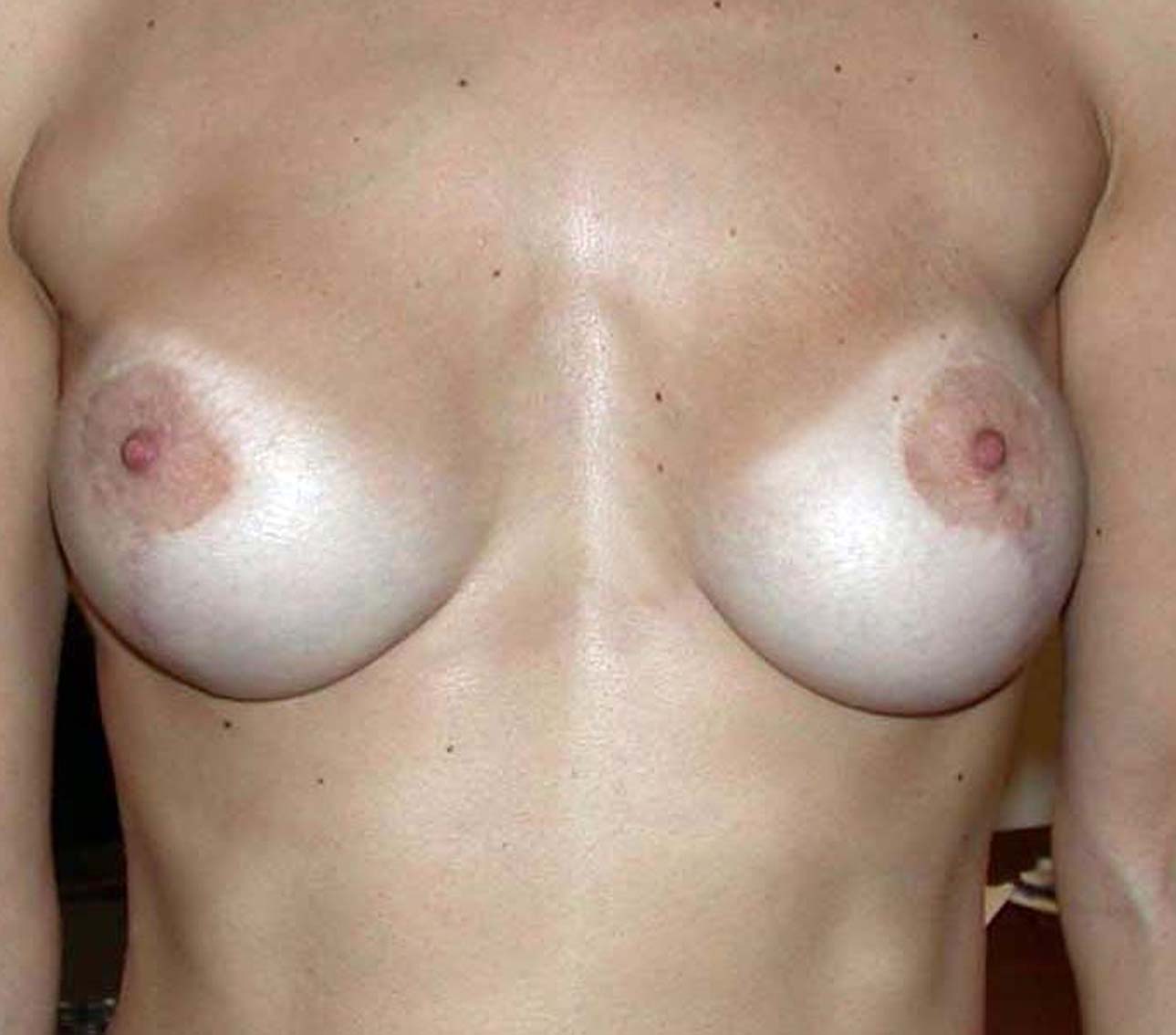 chirurgie-esthétique-correction-ptose-avec-implants15