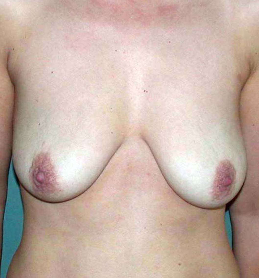 chirurgie-esthétique-correction-ptose-avec-implants18