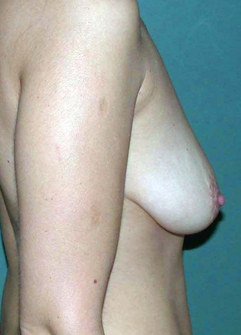 chirurgie-esthétique-correction-ptose-avec-implants20