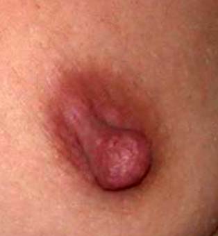 chirurgie-esthetique-pierre-nahon-reduction mammelon00