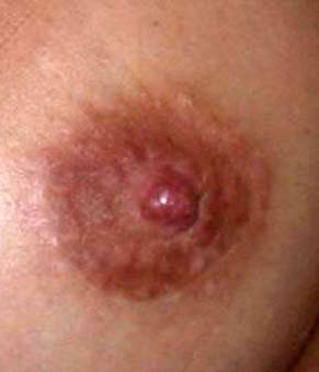 chirurgie-esthetique-pierre-nahon-reduction mammelon01