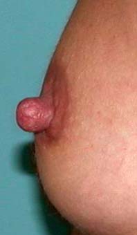 chirurgie-esthetique-pierre-nahon-reduction mammelon02