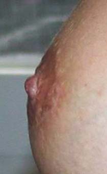 chirurgie-esthetique-pierre-nahon-reduction mammelon03