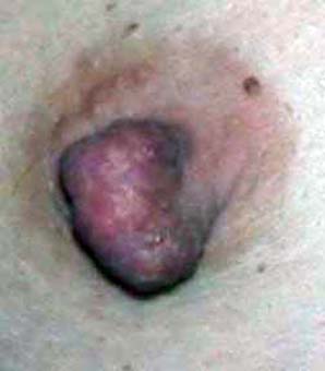 chirurgie-esthetique-pierre-nahon-reduction mammelon04