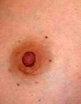 chirurgie-esthetique-pierre-nahon-reduction mammelon05