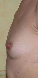 chirurgie-esthetique-pierre-nahon-reduction mammelon06