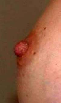 chirurgie-esthetique-pierre-nahon-reduction mammelon07