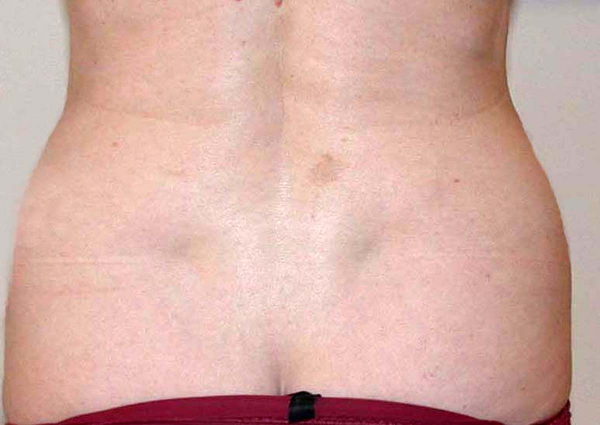 chirurgie-esthetique-pnahon-lipoaspirations01