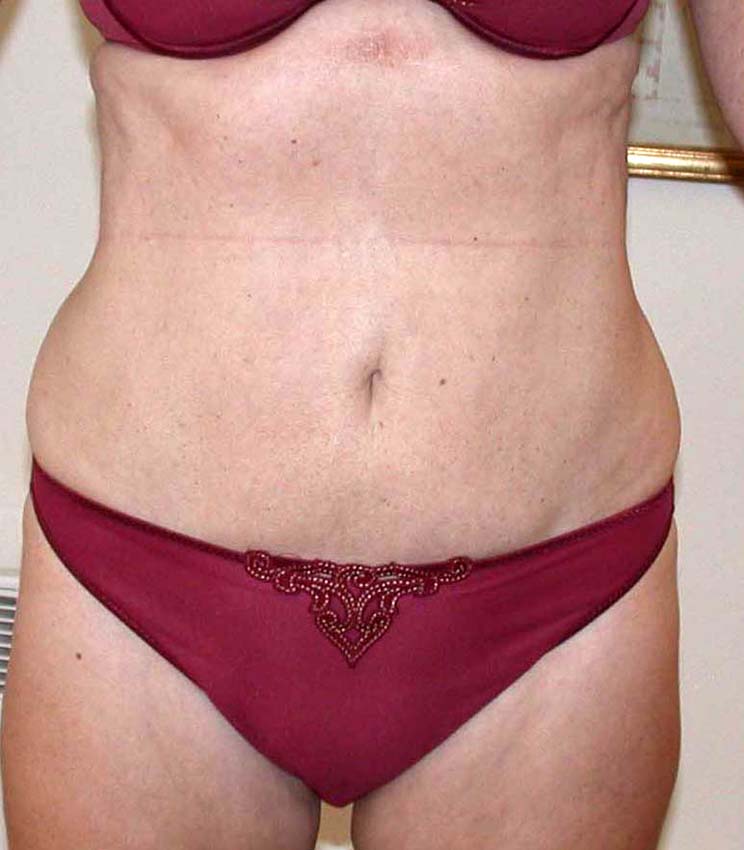 chirurgie-esthetique-pnahon-lipoaspirations03