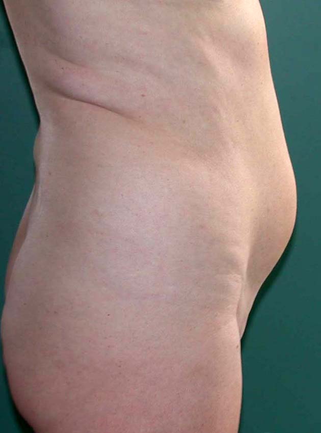 chirurgie-esthetique-pnahon-lipoaspirations04