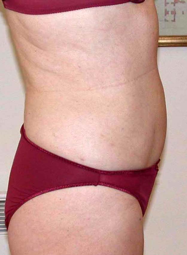 chirurgie-esthetique-pnahon-lipoaspirations05