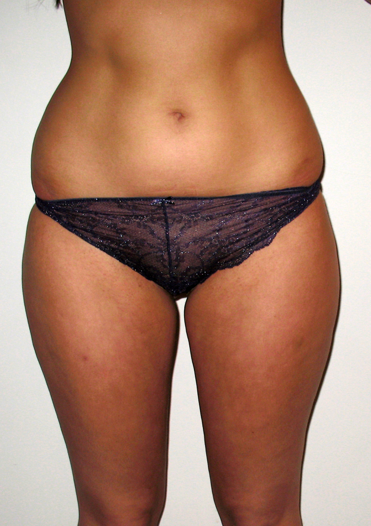 chirurgie-esthetique-pnahon-lipoaspirations06