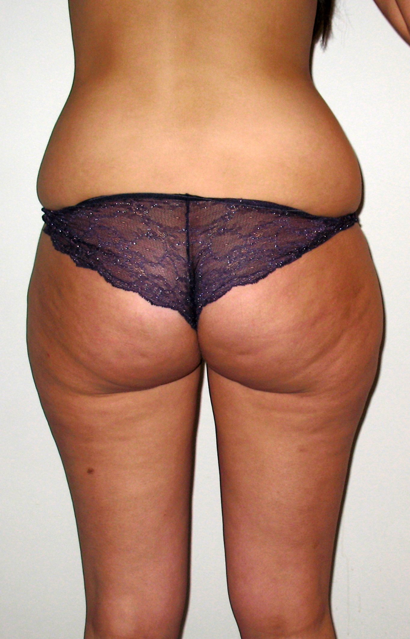 chirurgie-esthetique-pnahon-lipoaspirations08