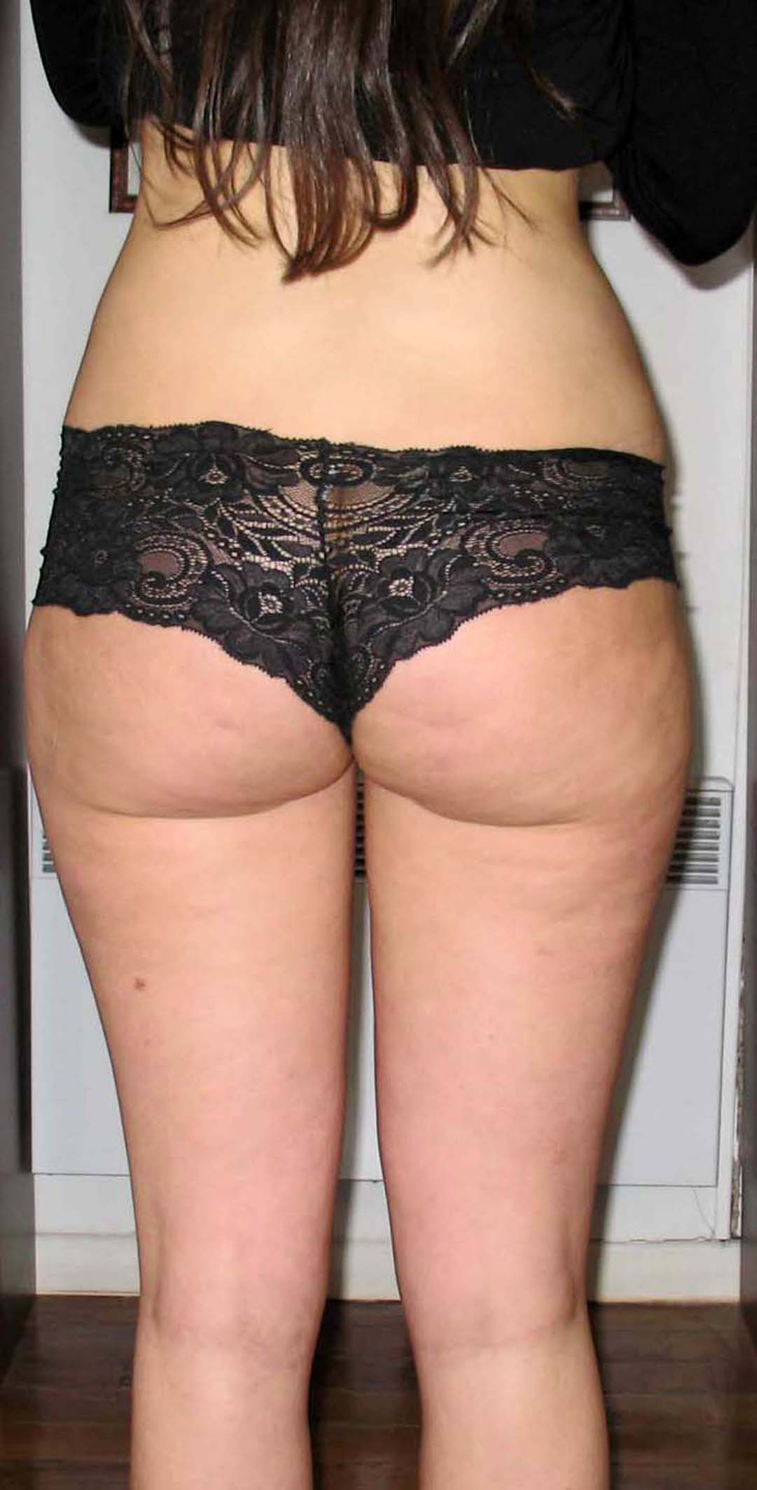 chirurgie-esthetique-pnahon-lipoaspirations09