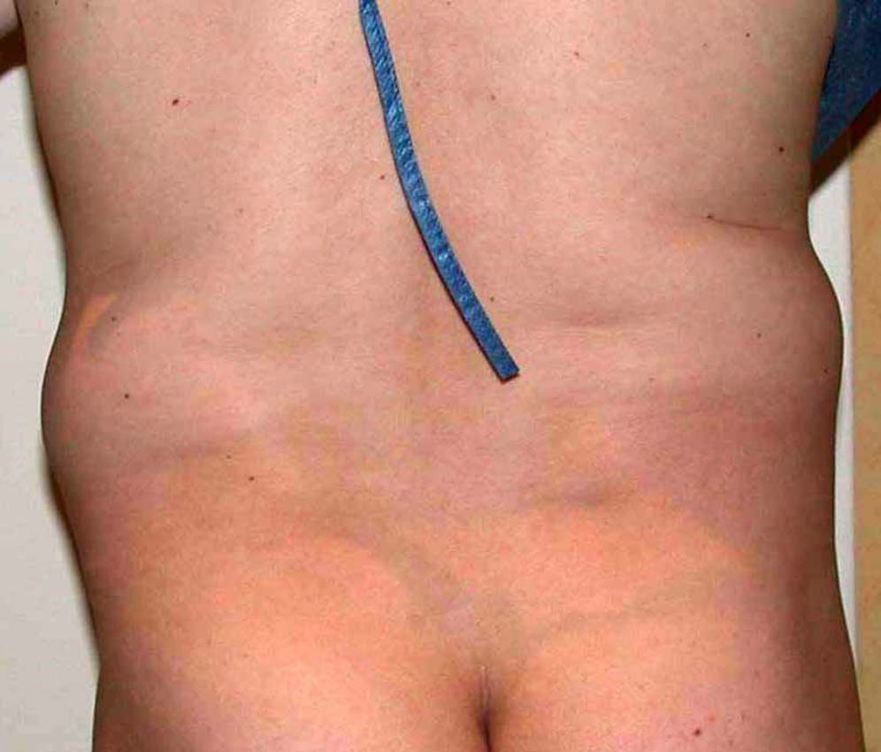 chirurgie-esthetique-pnahon-lipoaspirations10