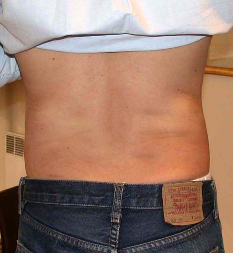 chirurgie-esthetique-pnahon-lipoaspirations11