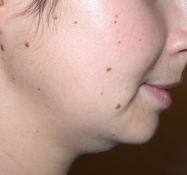 chirurgie-esthetique-pnahon-lipoaspirations12