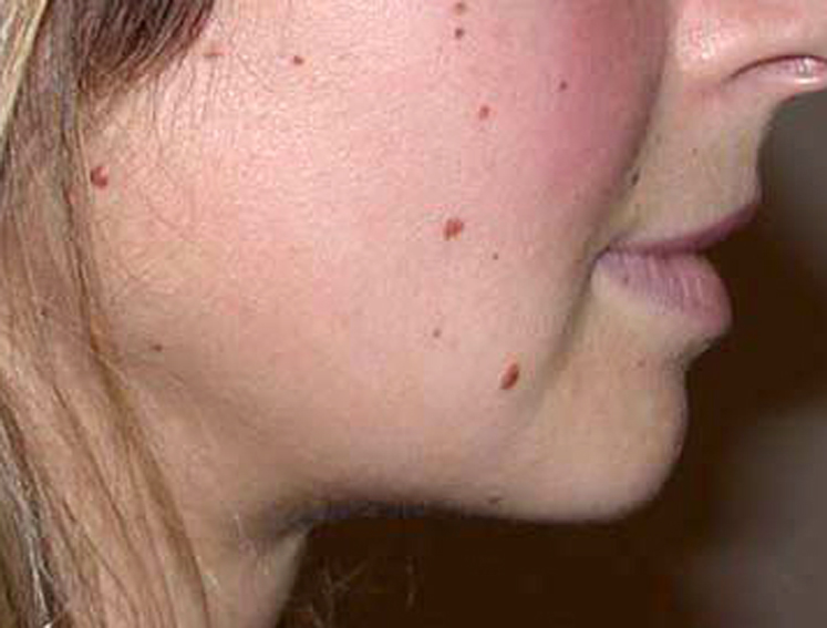 chirurgie-esthetique-pnahon-lipoaspirations13