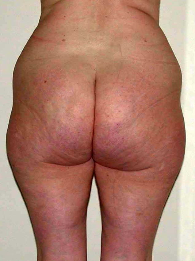 chirurgie-esthetique-pnahon-lipoaspirations14