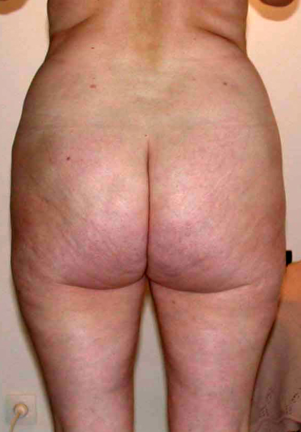 chirurgie-esthetique-pnahon-lipoaspirations15