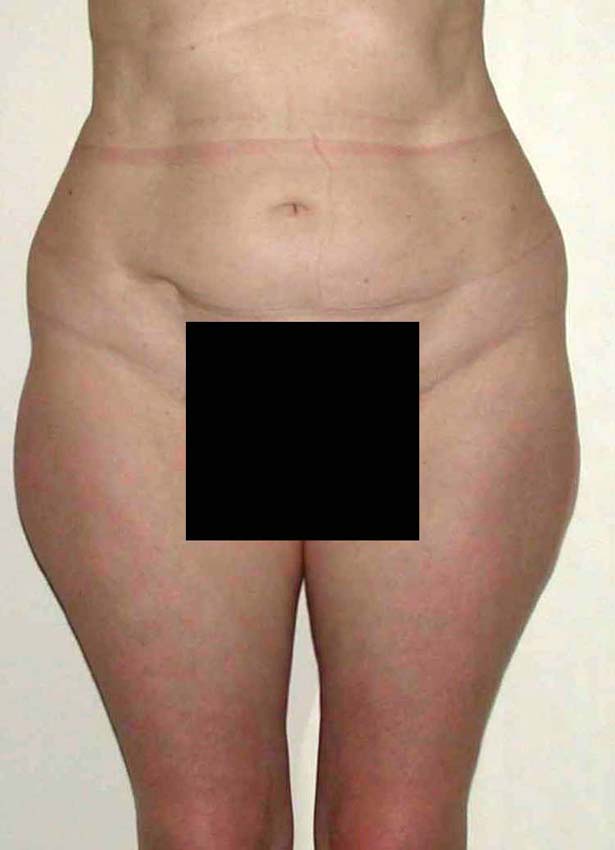 chirurgie-esthetique-pnahon-lipoaspirations16