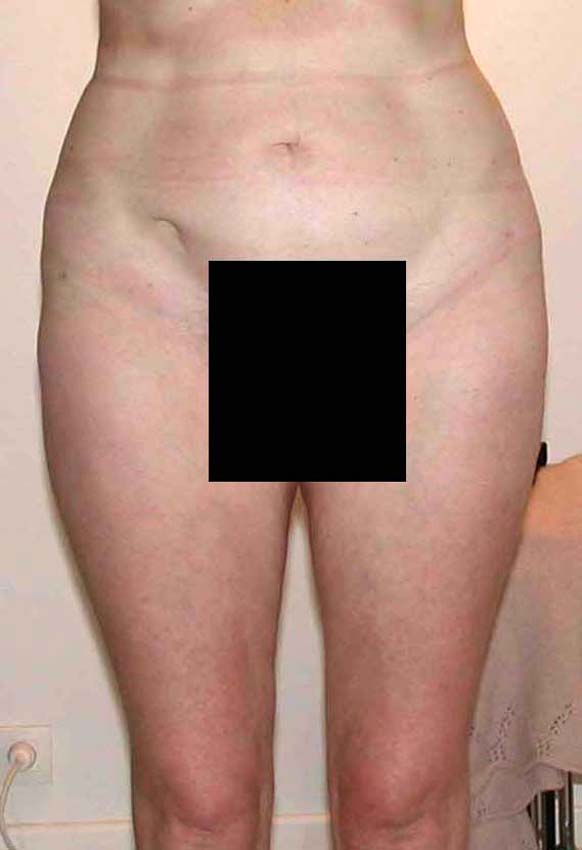 chirurgie-esthetique-pnahon-lipoaspirations17