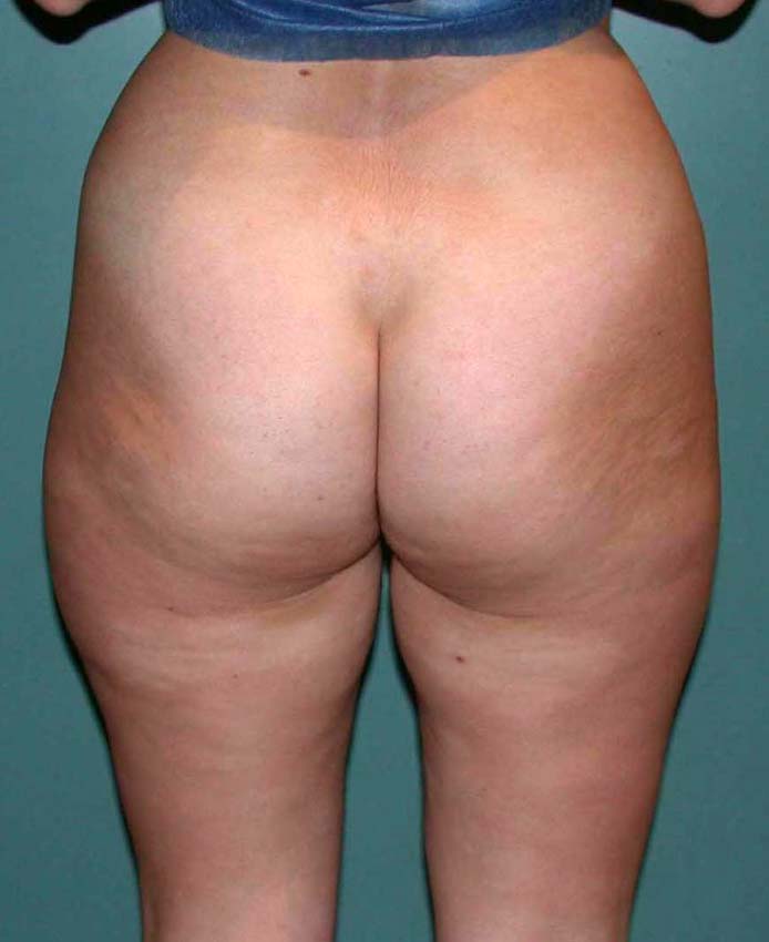 chirurgie-esthetique-pnahon-lipoaspirations18
