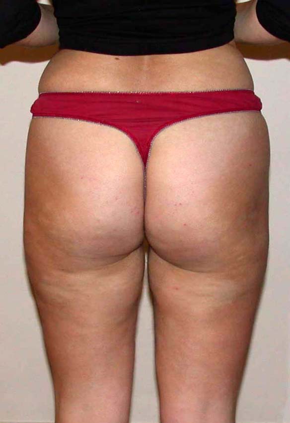 chirurgie-esthetique-pnahon-lipoaspirations19