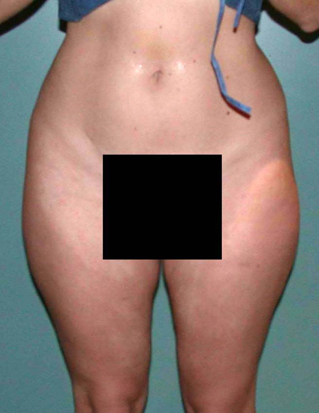 chirurgie-esthetique-pnahon-lipoaspirations20