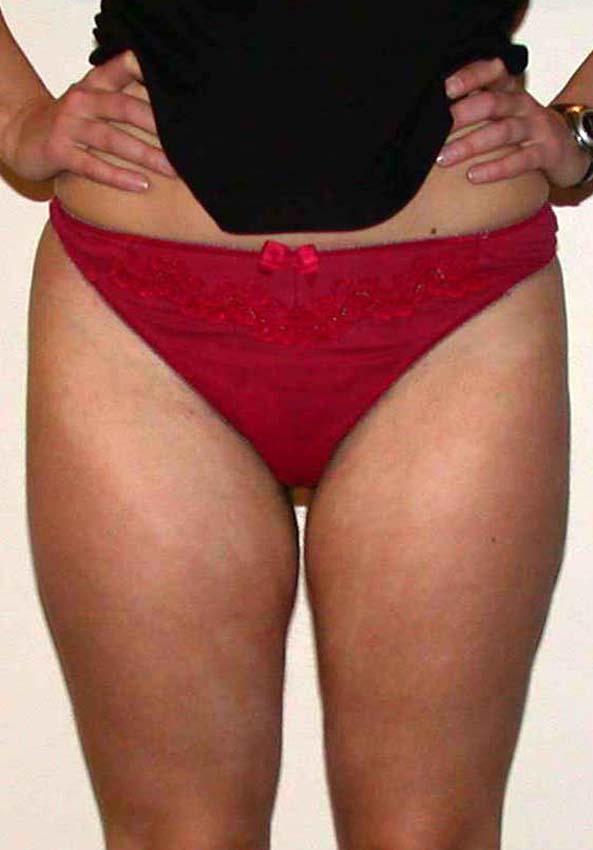 chirurgie-esthetique-pnahon-lipoaspirations21