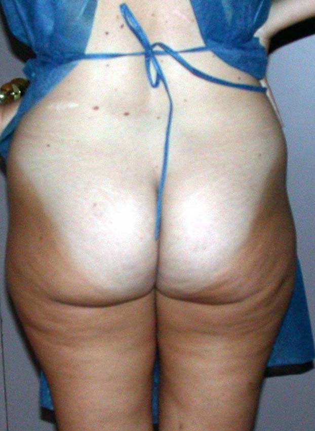 chirurgie-esthetique-pnahon-lipoaspirations22