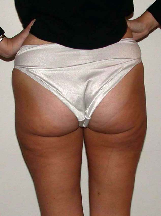 chirurgie-esthetique-pnahon-lipoaspirations23