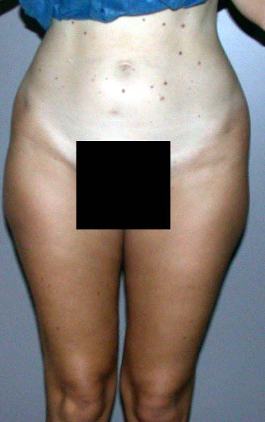 chirurgie-esthetique-pnahon-lipoaspirations24