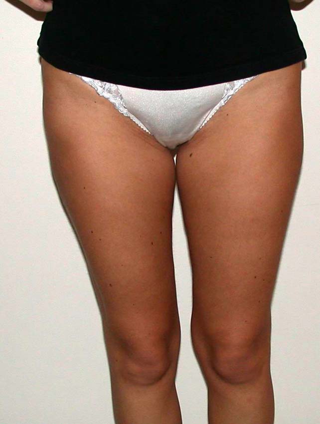 chirurgie-esthetique-pnahon-lipoaspirations25