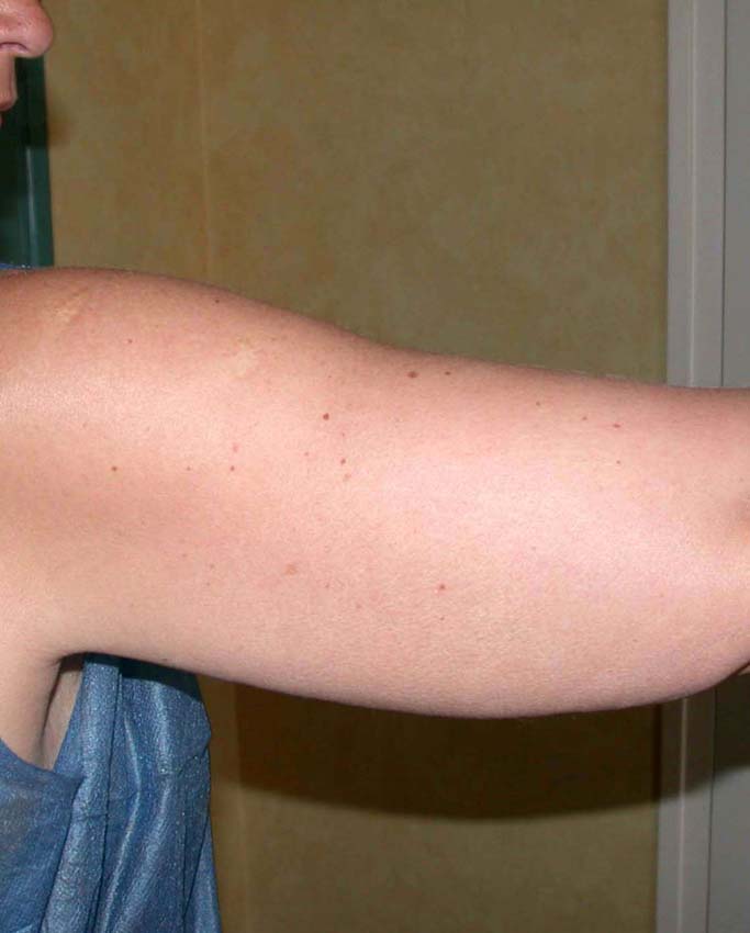 chirurgie-esthetique-pnahon-lipoaspirations26