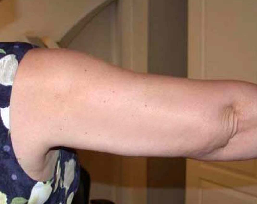 chirurgie-esthetique-pnahon-lipoaspirations27