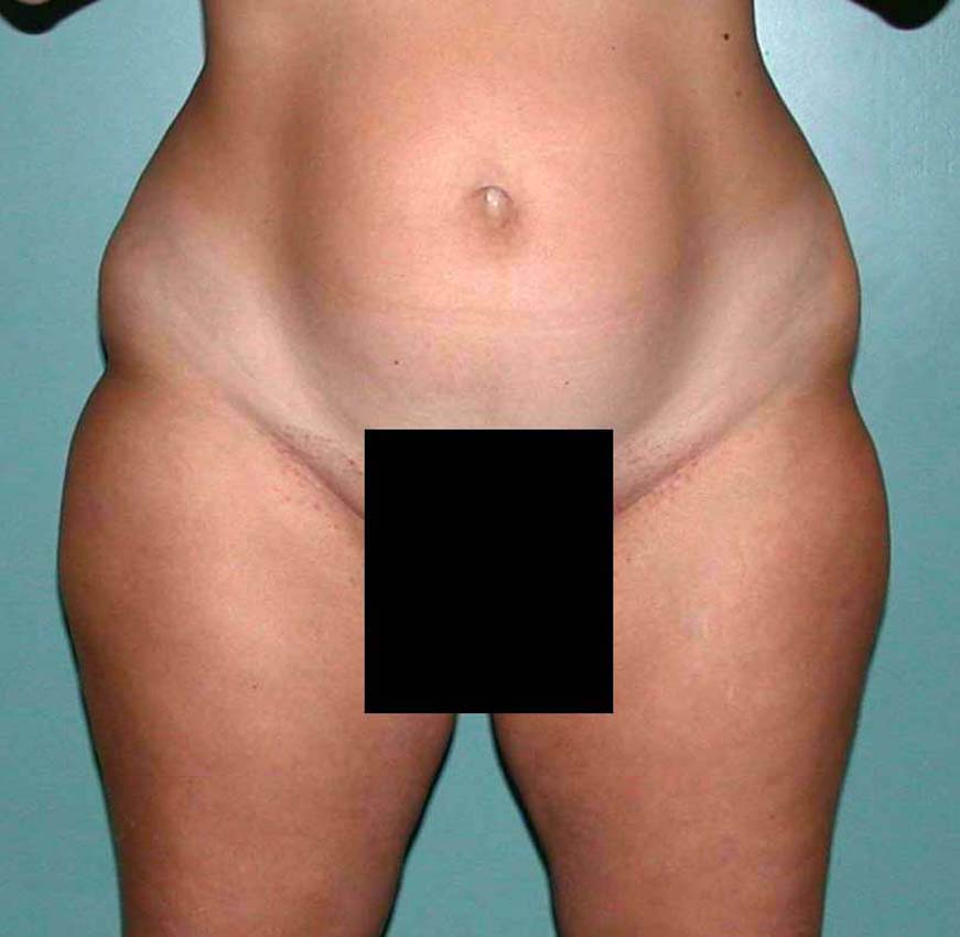 chirurgie-esthetique-pnahon-lipoaspirations28