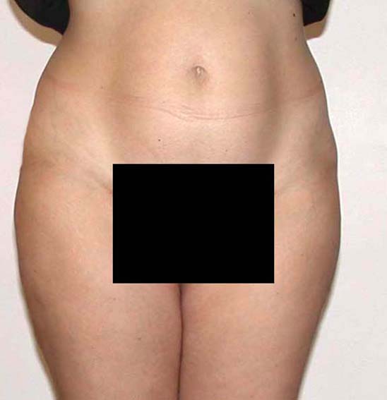chirurgie-esthetique-pnahon-lipoaspirations29