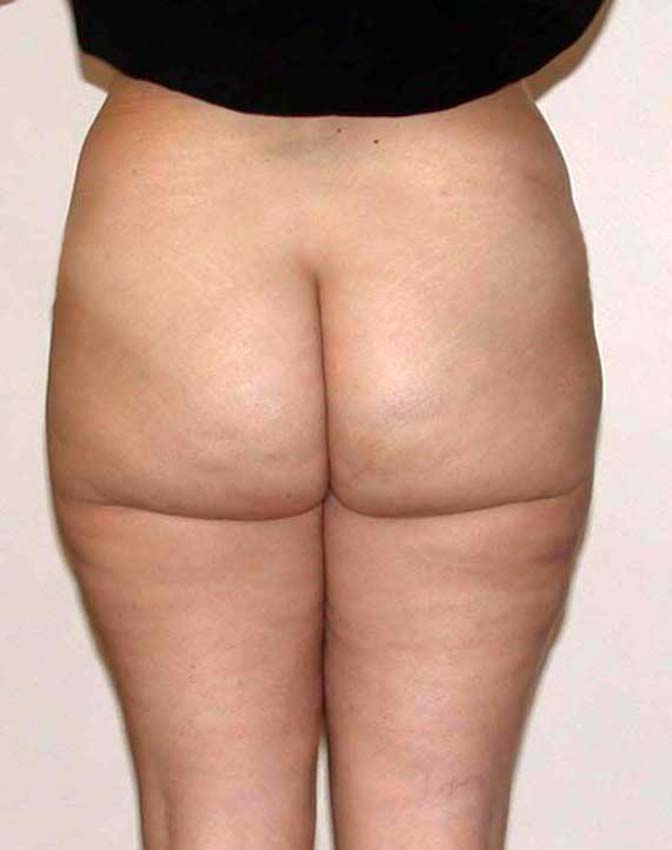 chirurgie-esthetique-pnahon-lipoaspirations31