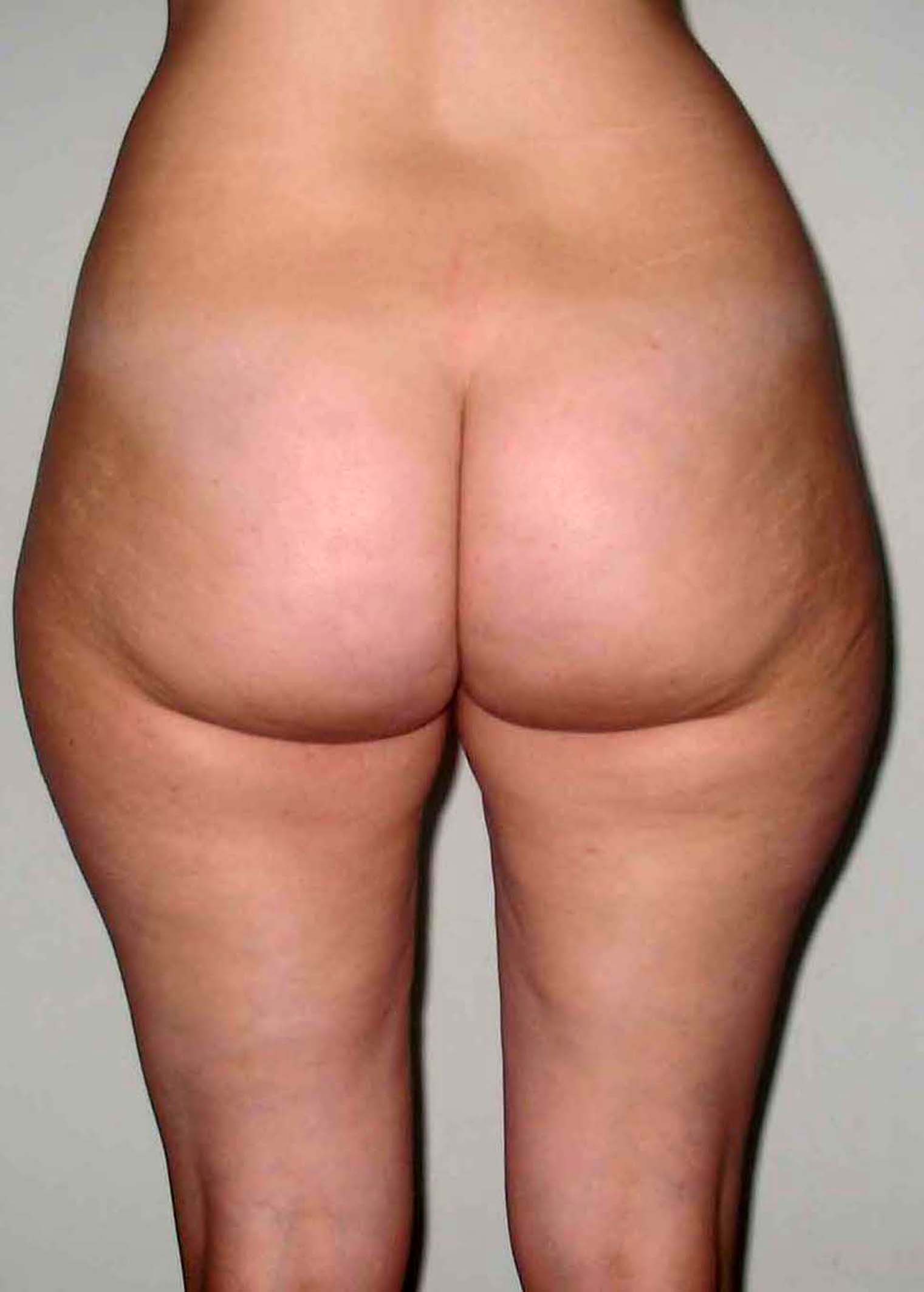chirurgie-esthetique-pnahon-lipoaspirations32