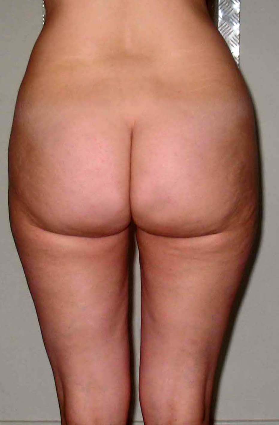 chirurgie-esthetique-pnahon-lipoaspirations33