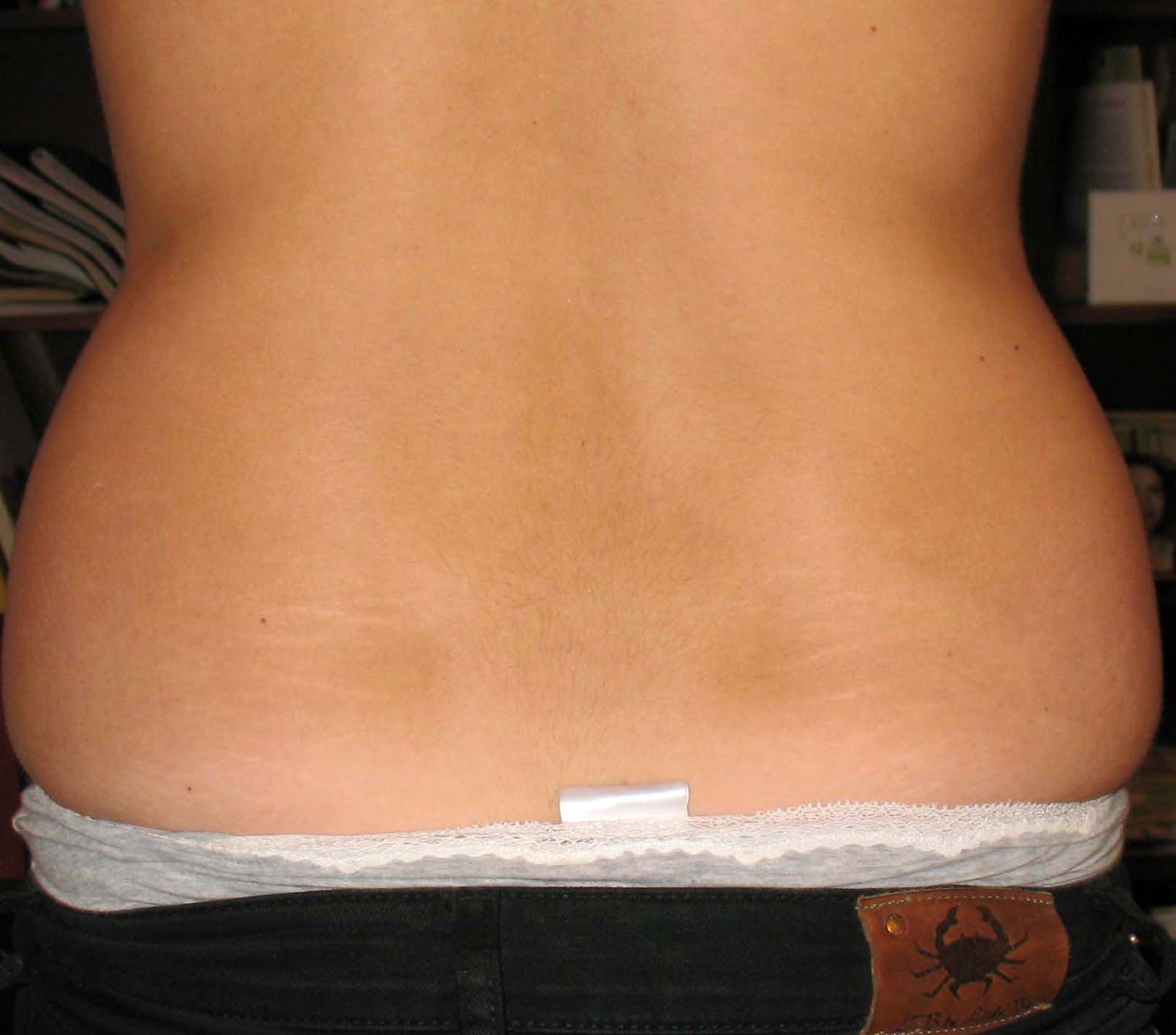 chirurgie-esthetique-pnahon-lipoaspirations34