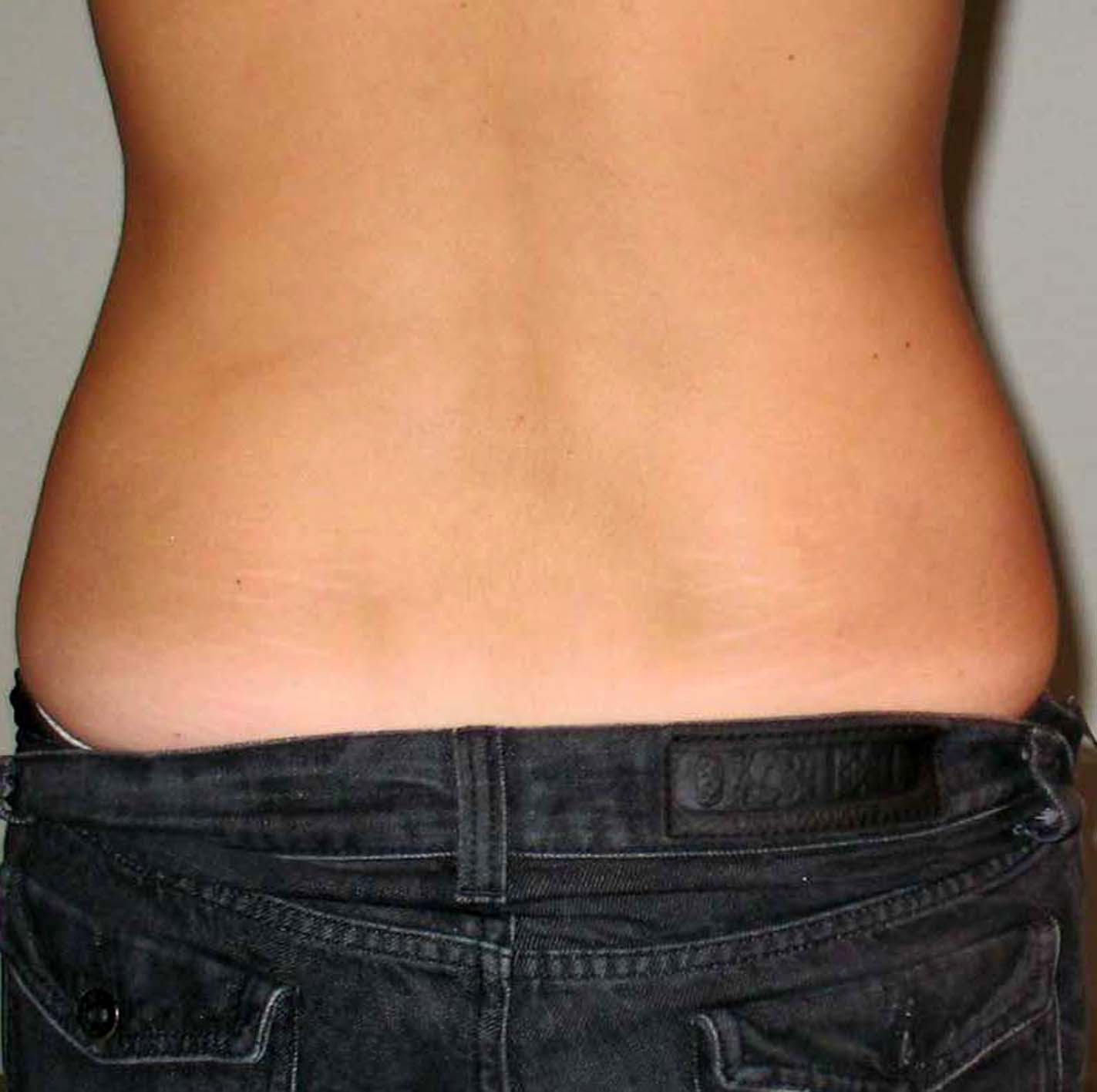 chirurgie-esthetique-pnahon-lipoaspirations35