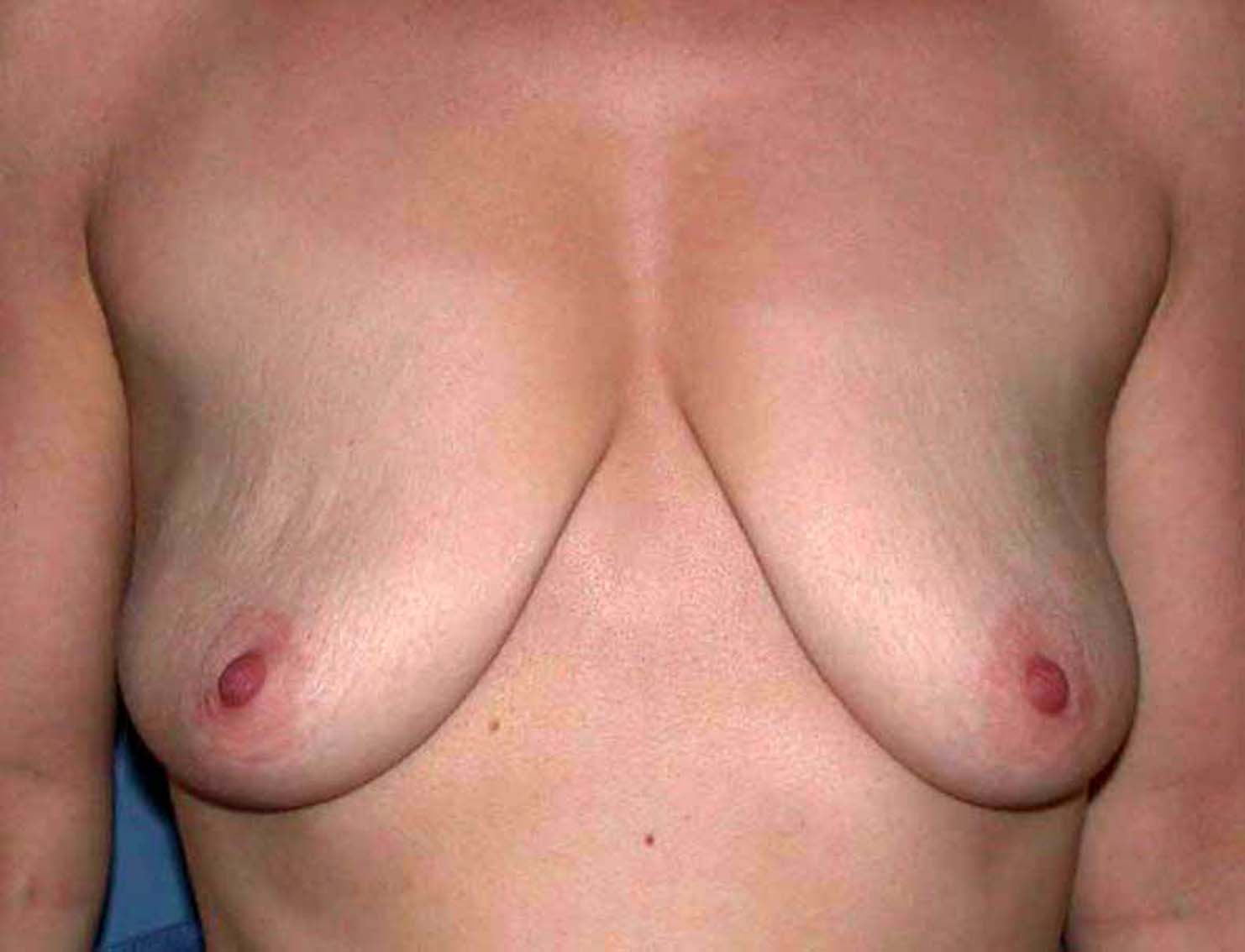 chirurgie-esthetique-ptose-sans-implant00