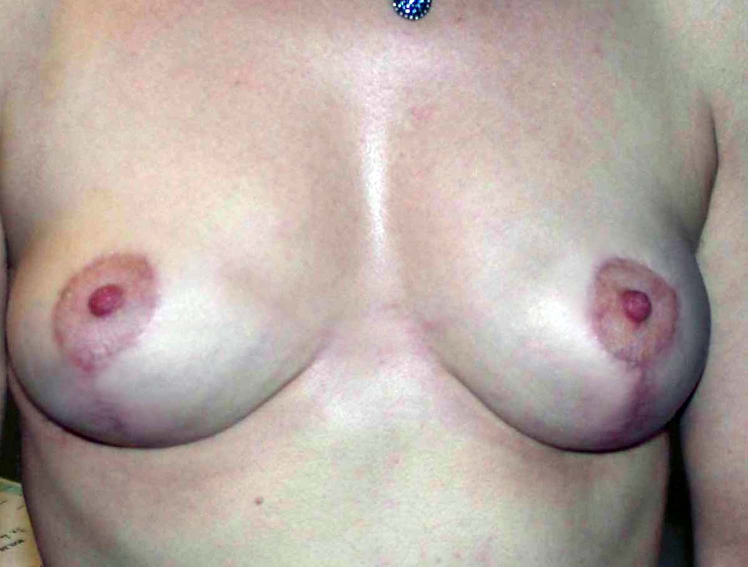 chirurgie-esthetique-ptose-sans-implant01