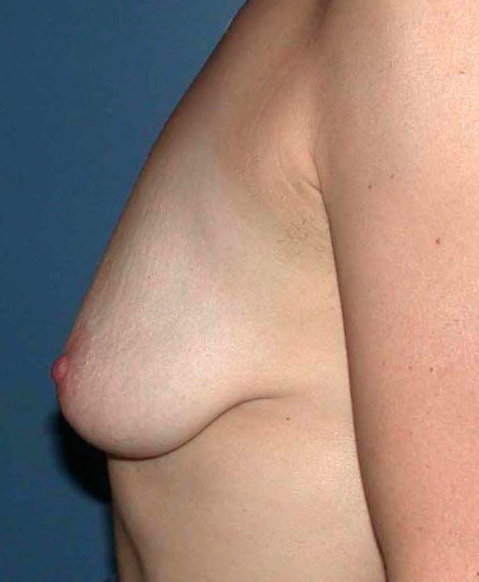 chirurgie-esthetique-ptose-sans-implant02