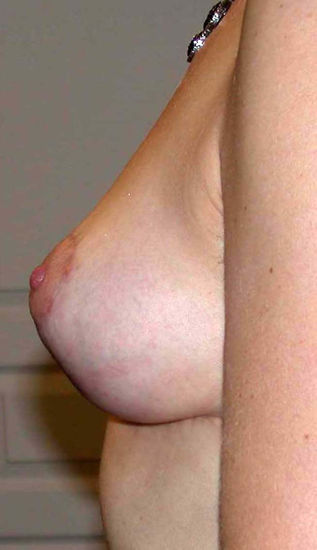 chirurgie-esthetique-ptose-sans-implant03