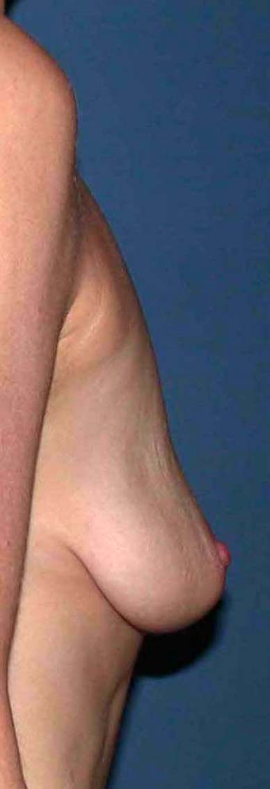 chirurgie-esthetique-ptose-sans-implant04