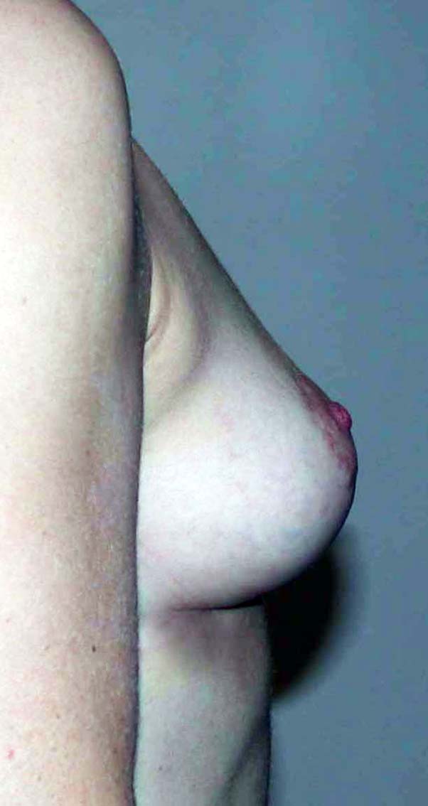 chirurgie-esthetique-ptose-sans-implant05